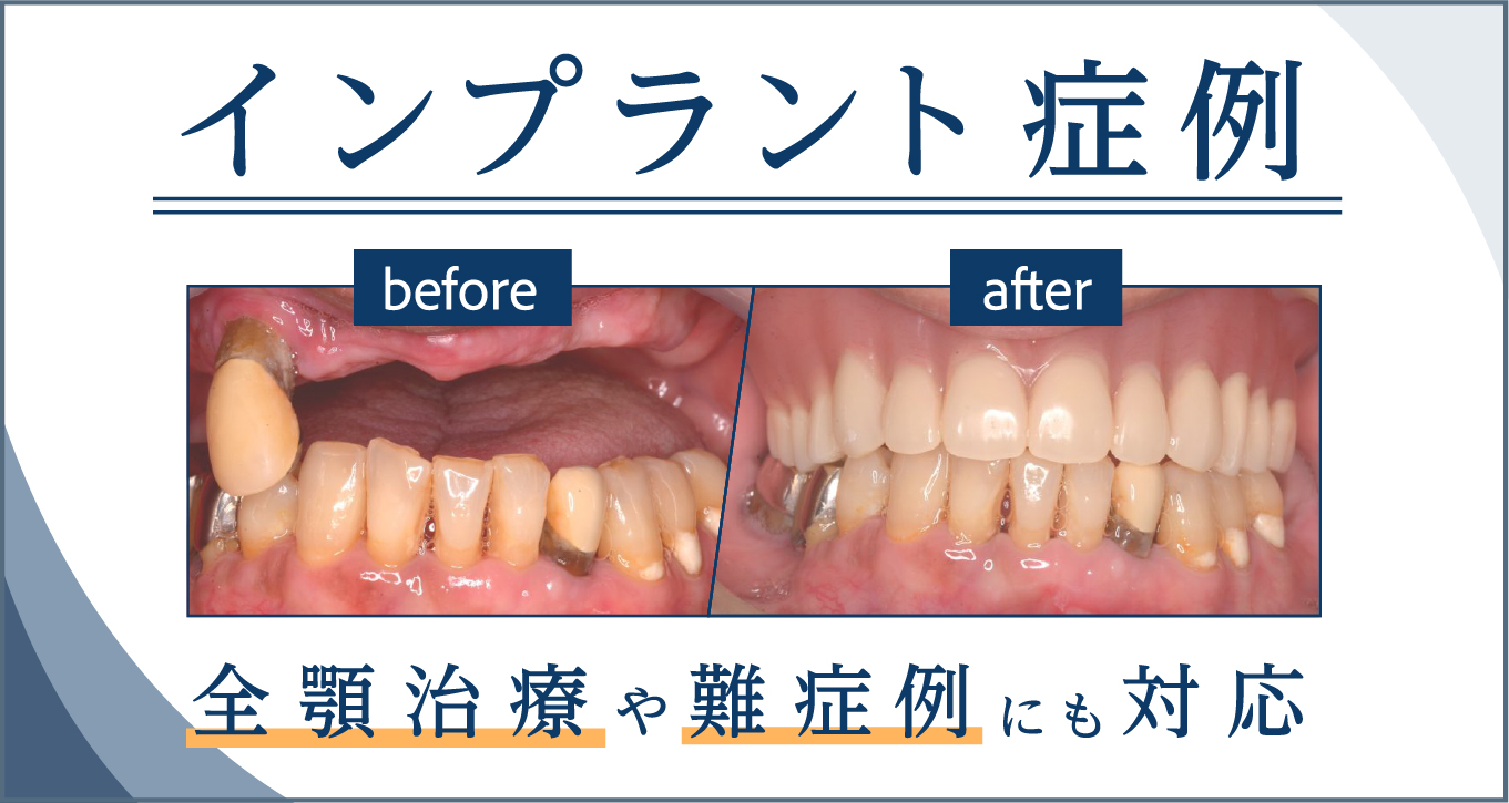 インプラント症例